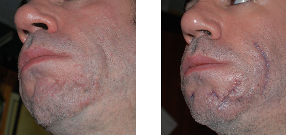 Acne Scar Revision