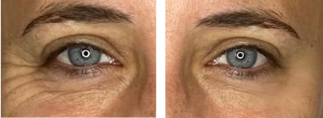 Anti-Wrinkle Injections