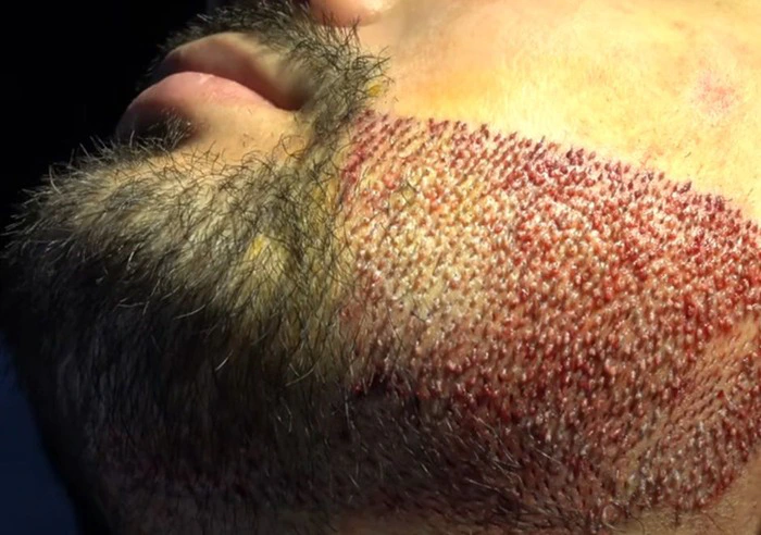 Beard Transplant