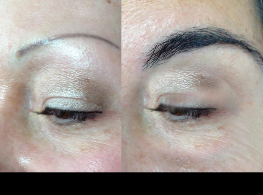 Eyebrow Transplant