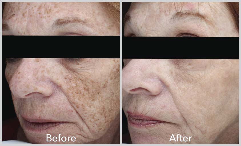 LASER Photofacial