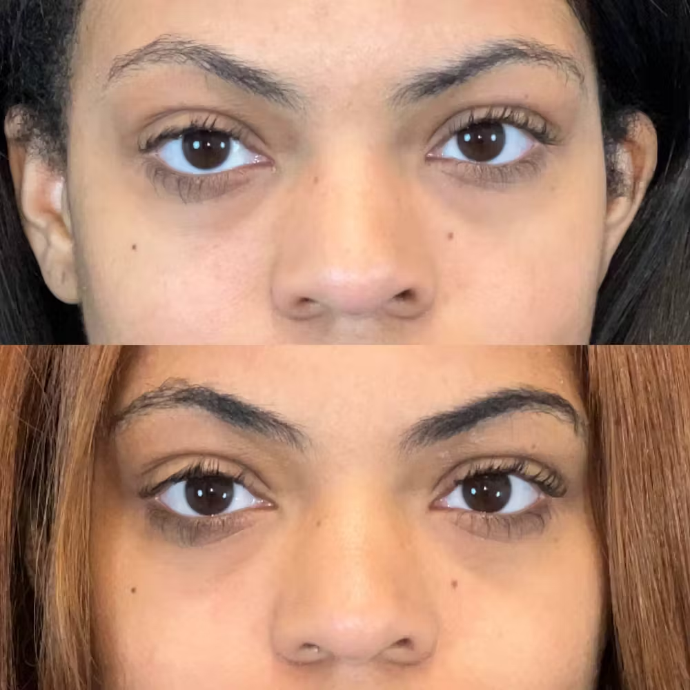 Lower Blepharoplasty